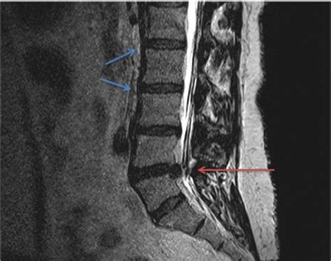MRI is the gold standard in the evaluation of a suspected lumbar disk herniation. . Herniated nucleus pulposus diagnostic tests